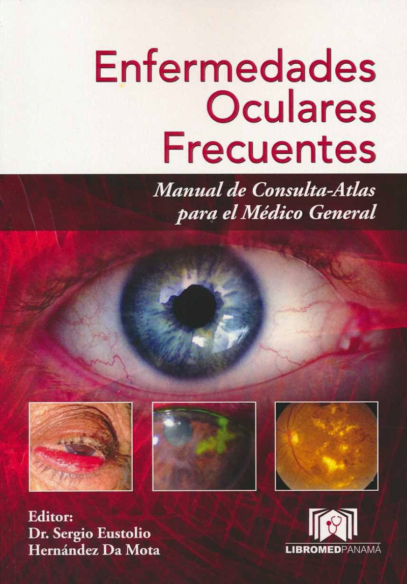 Enfermedades oculares frecuentes : manual de consulta-atlas para el médico general / editor: Dr. Sergio Eustolio Hernández Da Mota
